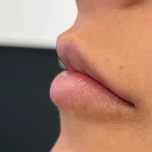 Lip filler client 1 — before