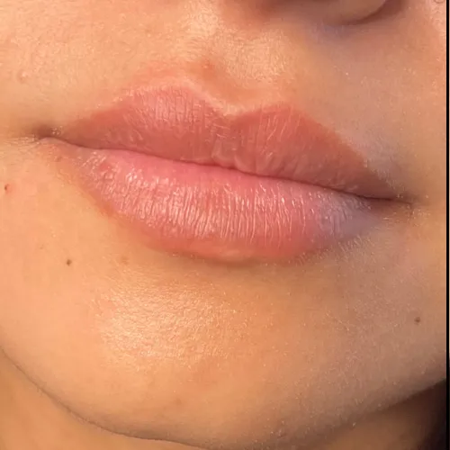 Lip filler client 2 — before